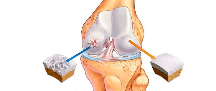 Deformierende Arthrose des Kniegelenks (links) und ein gesundes Gelenk (rechts)